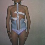  Corset Milwoke con casquete lumbo sacro barras posteriores y anteriores que hacen de sostén y extensión del mentón y occipital por medio de un arco de contención 