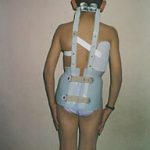  Corset Milwoke con casquete lumbo sacro barras posteriores y anteriores que hacen de sostén y extensión del mentón y occipital por medio de un arco de contención 